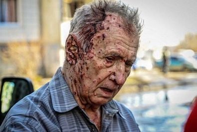  یکی از مجروحان حملات روسیه به اوکراین